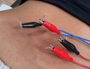 dry needling back